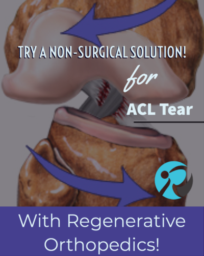 ACL Tear