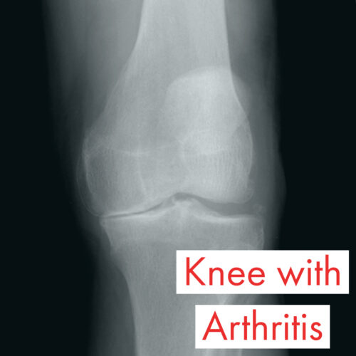 Knee Arthritis