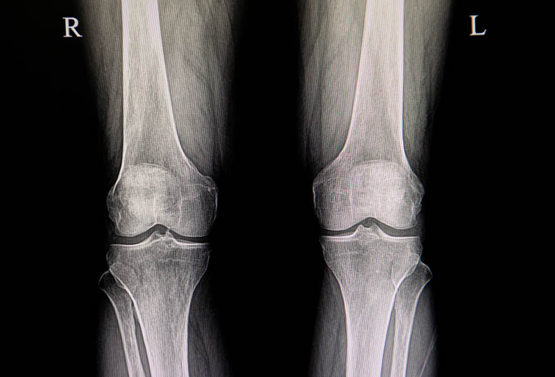 Regenerative Orthopedics 