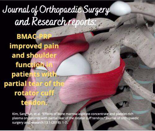 Non-Surgical Partial Rotator Cuff Tear Repair