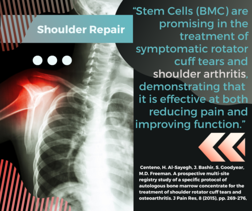 Shoulder Arthritis